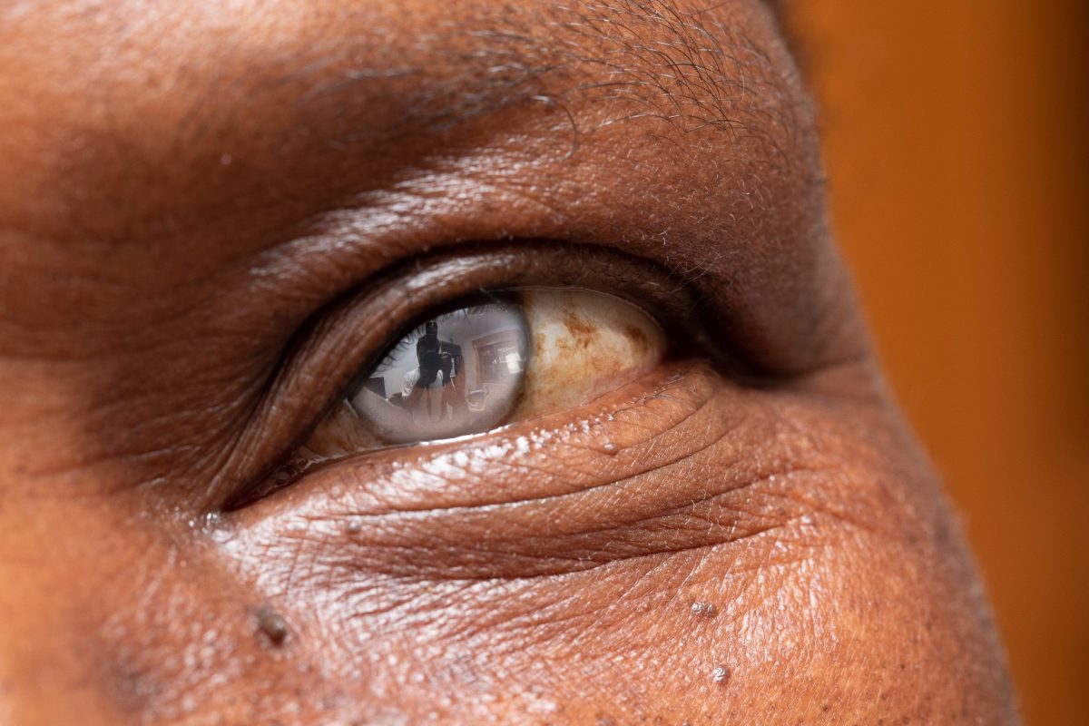 A close-up view on the iris of an old-aged African male with a cataract. Bloodshot eyes with degenerative eyesight disease. Copy space on the right.